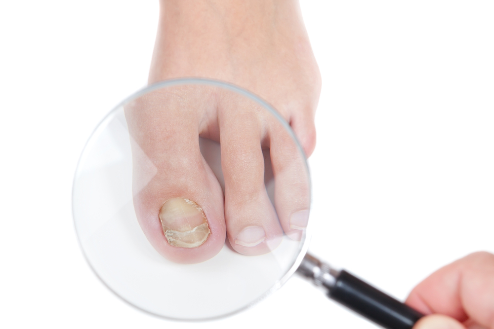 Micose de unhas: saiba como evitar infecções causadas por fungos