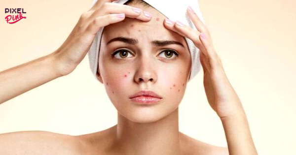 Conheça alguns hábitos comuns que pioram a acne